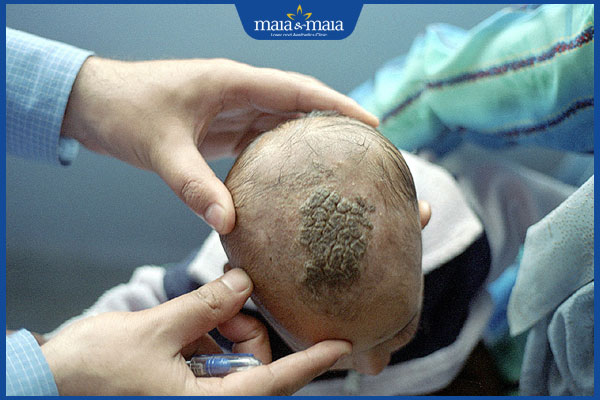 Nấm tổ ong da đầu: Dấu hiệu, mức độ nguy hiểm & cách xử lý 2 bị nấm tổ ong ở da dầu