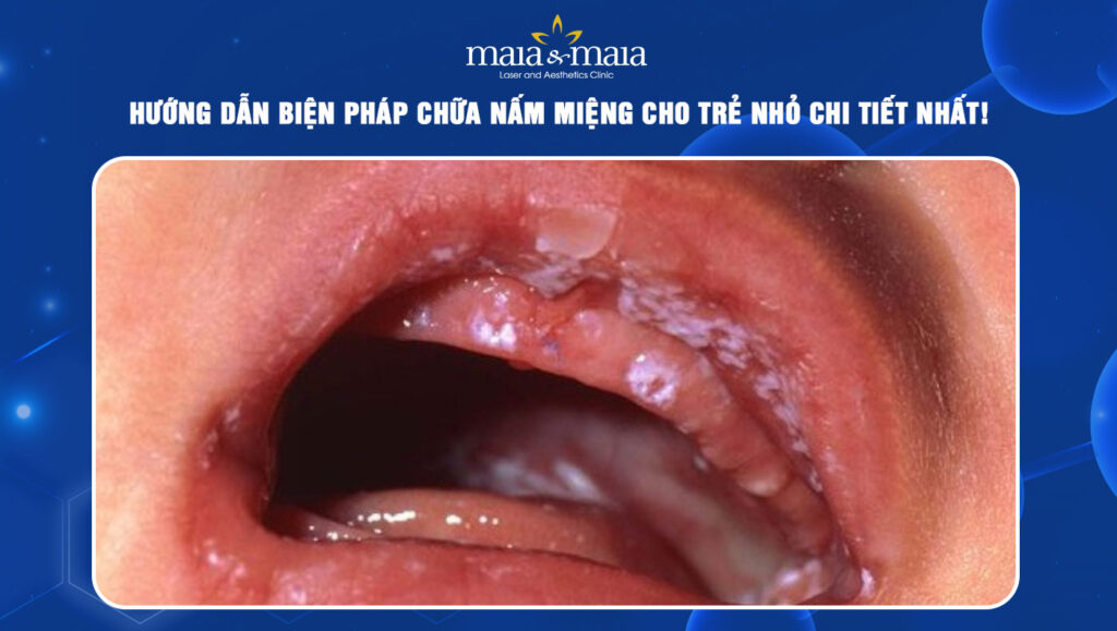 Hướng dẫn cách chữa nấm miệng cho trẻ nhỏ an toàn & hiệu quả 1 chữa nấm miệng cho trẻ