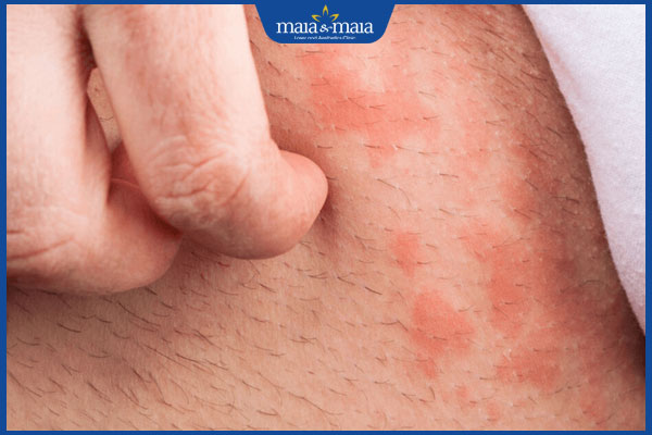 da bẹn viêm đỏ