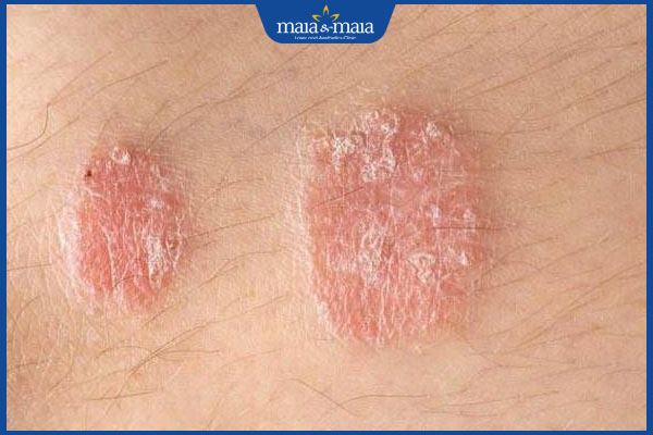 dấu hiệu nấm sợi