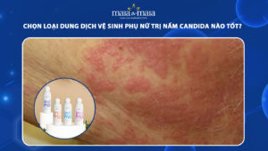 dung dịch vệ sinh phụ nữ trị nấm candida