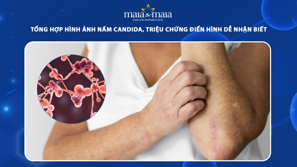 Tổng hợp hình ảnh nấm Candida để nhận biết bệnh nhanh chóng 1 hình ảnh nấm candida