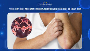 hình ảnh nấm candida