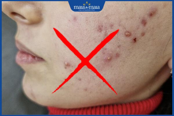 không dùng khi mụn viêm