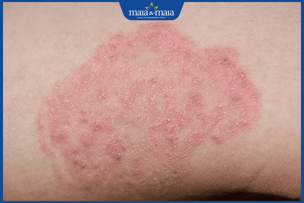 Nấm candida ở nam giới: Dấu hiệu và cách điều trị dứt điểm 2 mẩn ngứa đỏ