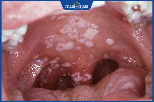 mảng trắng bám dày