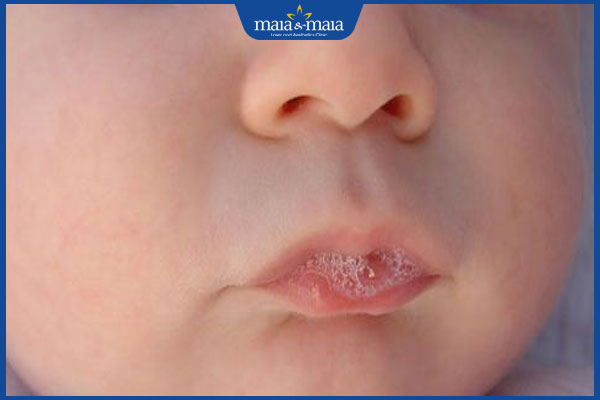 miệng trẻ ẩm ướt