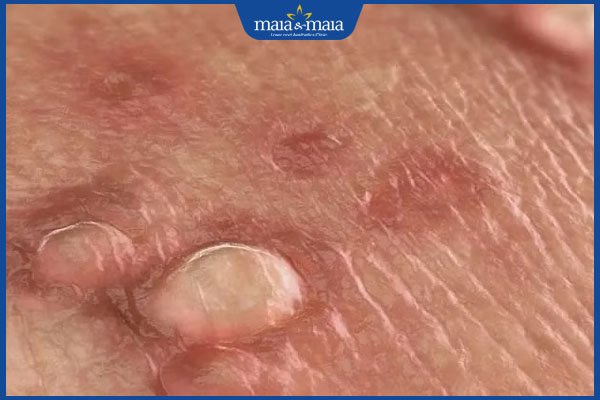 mụn nước dương vật