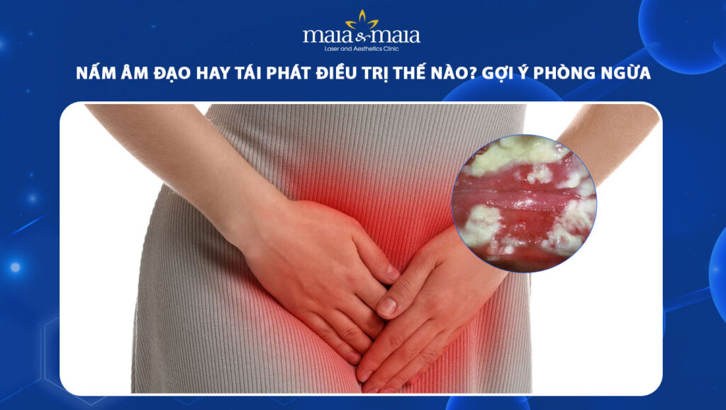 nấm âm đạo hay tái phát