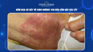 nấm bẹn có gây vô sinh không