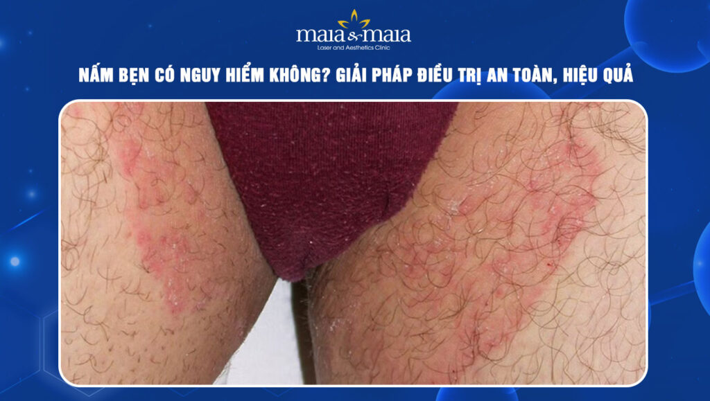 nấm bẹn có nguy hiểm không