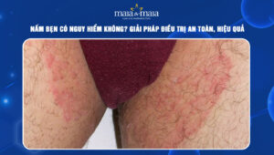 nấm bẹn có nguy hiểm không