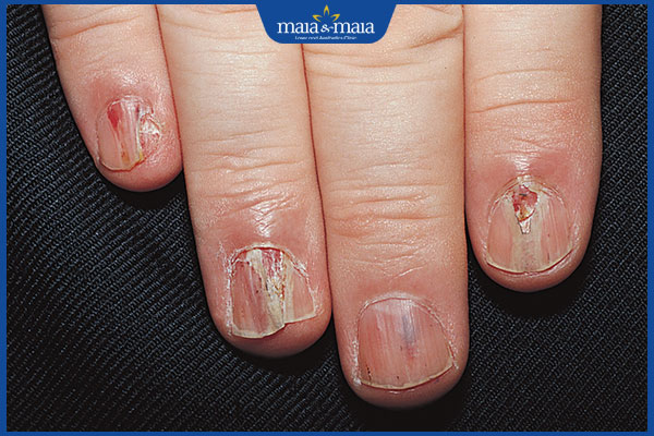 Tổng hợp hình ảnh nấm Candida để nhận biết bệnh nhanh chóng 9 nấm candida móng tay