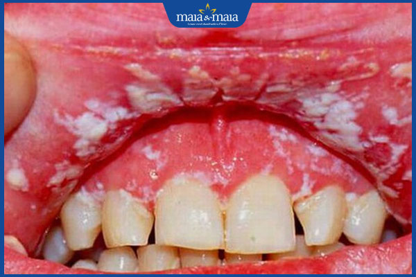 Tổng hợp hình ảnh nấm Candida để nhận biết bệnh nhanh chóng 7 nấm candida ở miệng