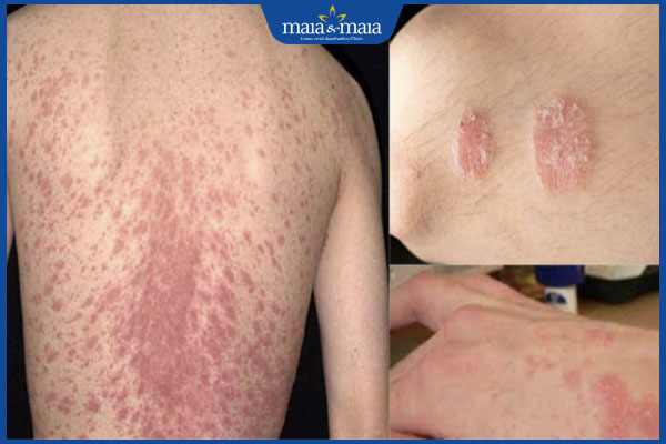 Tổng hợp hình ảnh nấm Candida để nhận biết bệnh nhanh chóng 5 nấm candida trên da