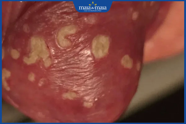 Tổng hợp hình ảnh nấm Candida để nhận biết bệnh nhanh chóng 4 nấm candida vùng kín nam