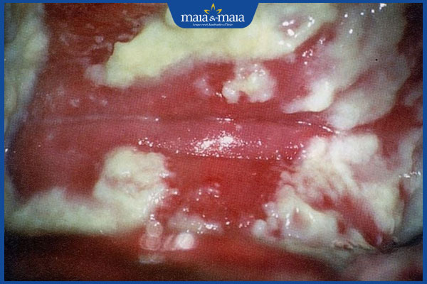 Tổng hợp hình ảnh nấm Candida để nhận biết bệnh nhanh chóng 2 nấm candida vùng kín nữ