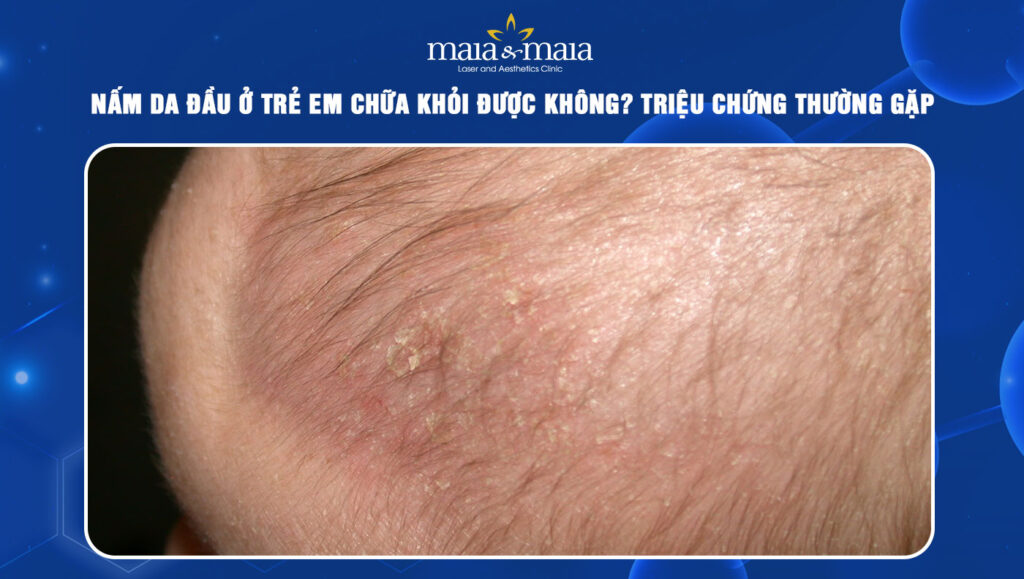 Nấm da đầu ở trẻ em: Triệu chứng nhận biết và cách điều trị 1 nấm da đầu ở trẻ em