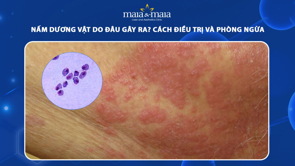 Nấm dương vật do đâu gây ra? Cách điều trị và phòng ngừa 1 nấm dương vật