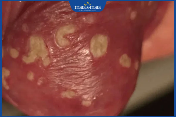 Nấm dương vật do đâu gây ra? Cách điều trị và phòng ngừa 3 nấm dương vật có mủ