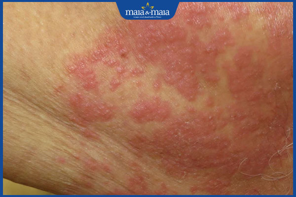 Nấm dương vật do đâu gây ra? Cách điều trị và phòng ngừa 2 nấm dương vật gây mẩn đỏ