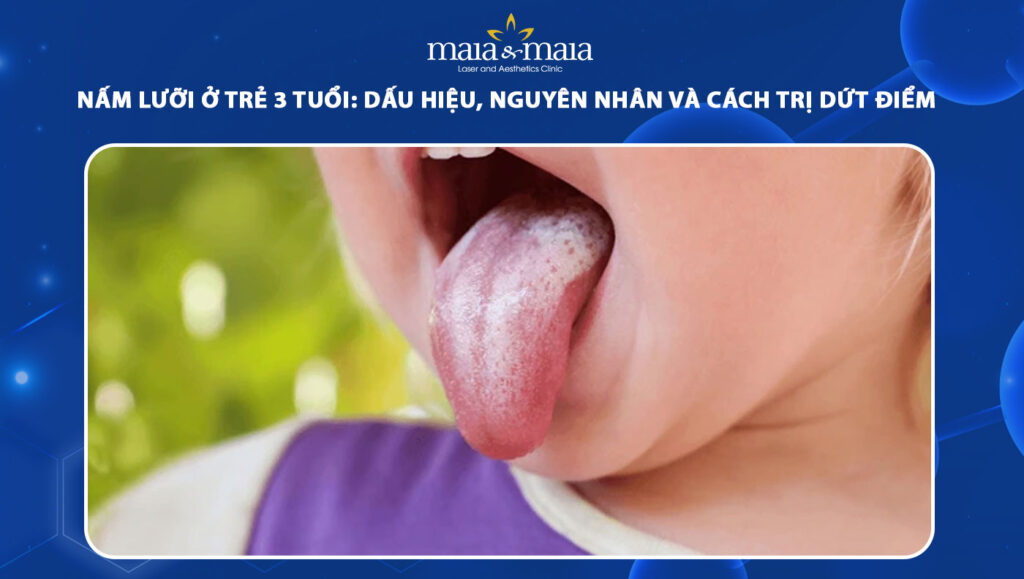 nấm lưỡi ở trẻ 3 tuổi