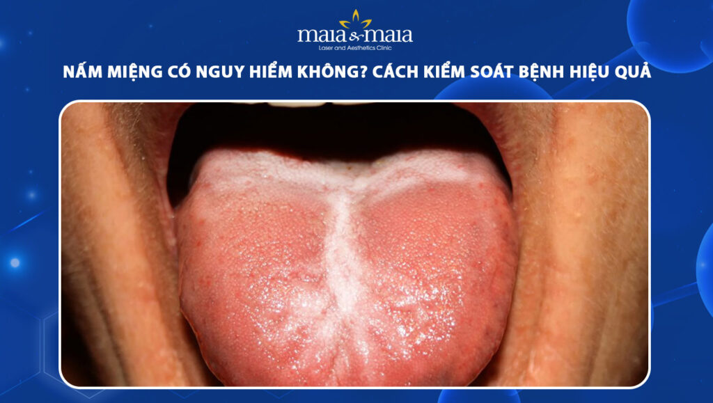 nấm miệng có nguy hiểm không