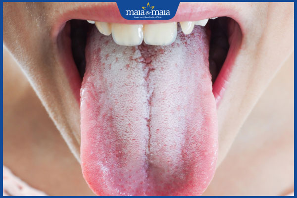 nấm miệng giai đoạn bùng phát