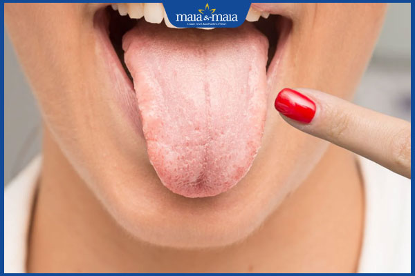 nấm miệng giai đoạn khởi phát