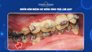 nấm miệng khi niềng răng