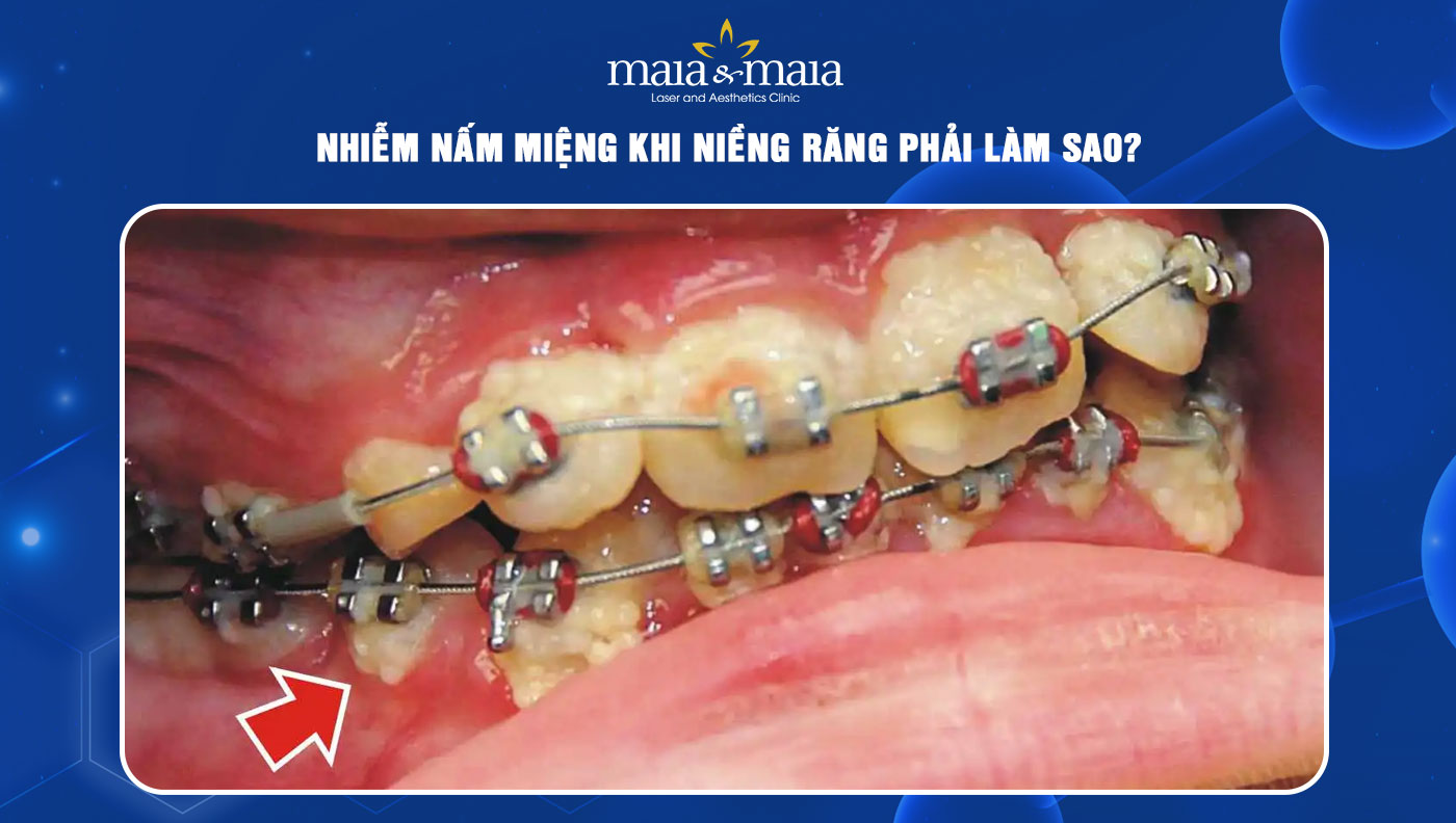 nấm miệng khi niềng răng