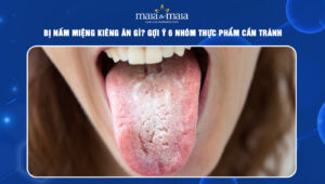 nấm miệng kiêng ăn gì