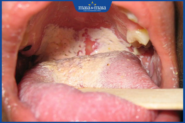 nấm miệng lan rộng