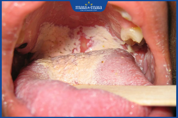 nấm miệng nặng