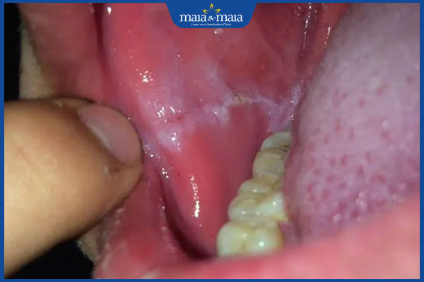 nấm miệng ở má trong