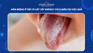 nấm miệng ở trẻ có gây sốt không