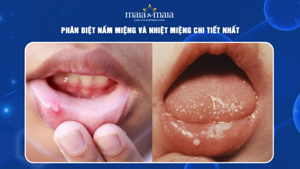 nấm miệng và nhiệt miệng