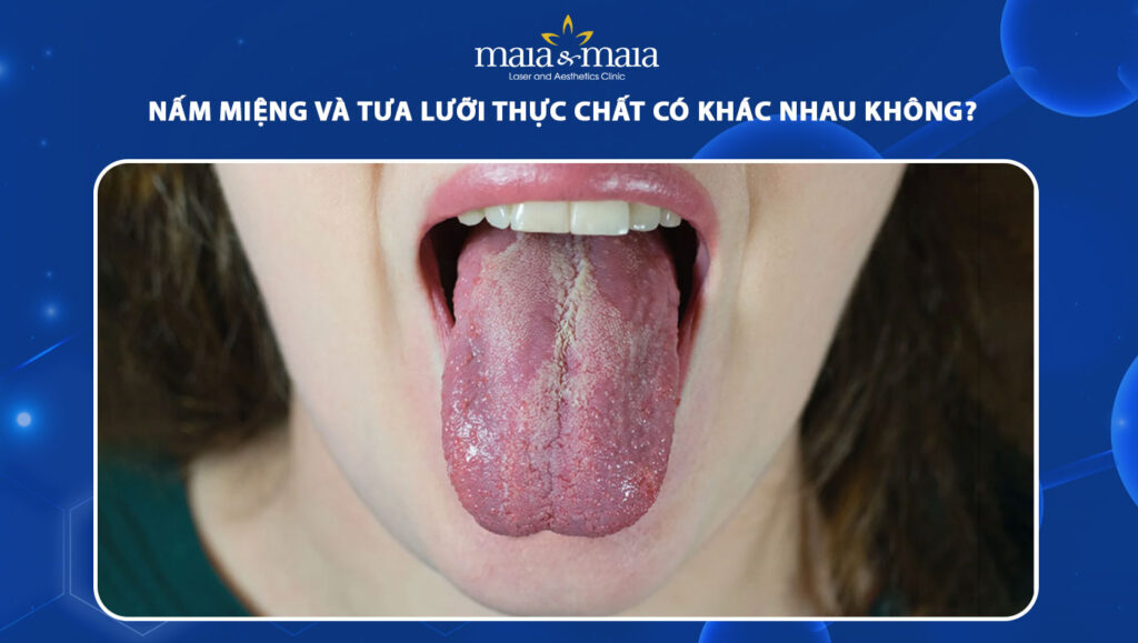 nấm miệng và tưa lưỡi