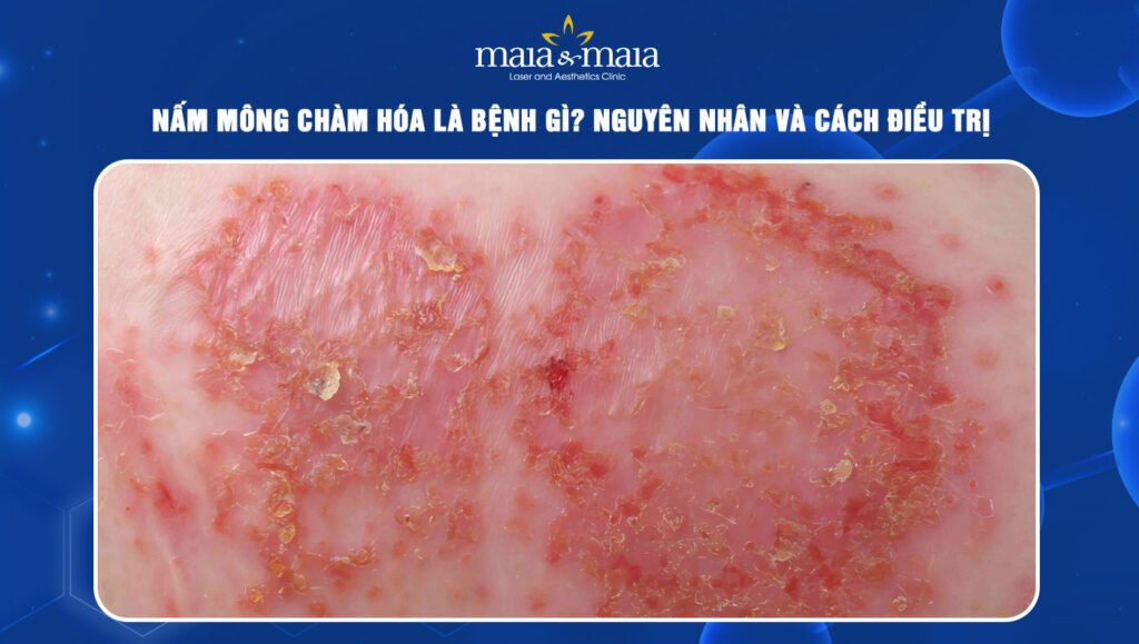 Nấm mông chàm hóa