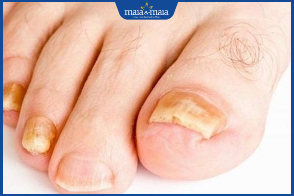 Tổng hợp hình ảnh nấm Candida để nhận biết bệnh nhanh chóng 11 nấm móng chân