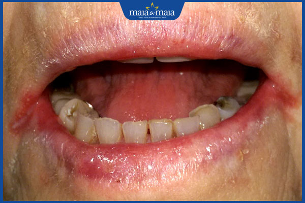 nấm ở khóe miệng