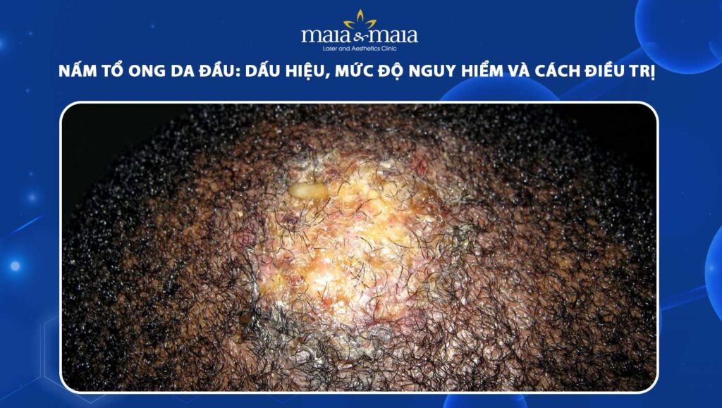 Nấm tổ ong da đầu: Dấu hiệu, mức độ nguy hiểm & cách xử lý 1 nấm tổ ong da đầu