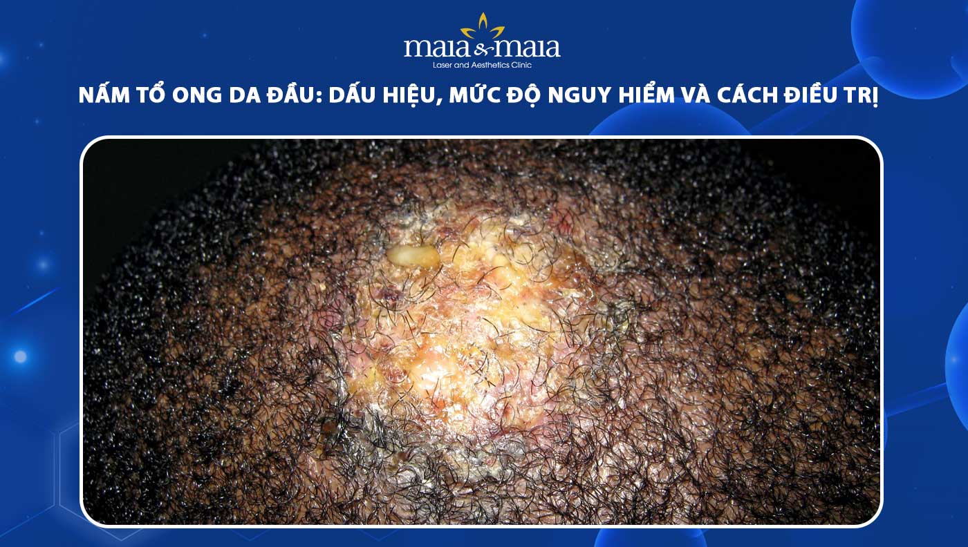 nấm tổ ong da đầu