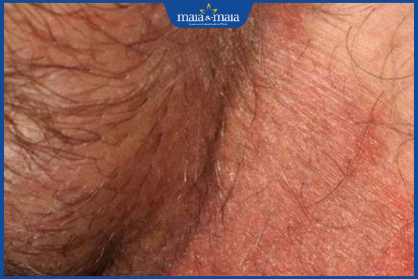 nấm vùng kín nổi mảng đỏ