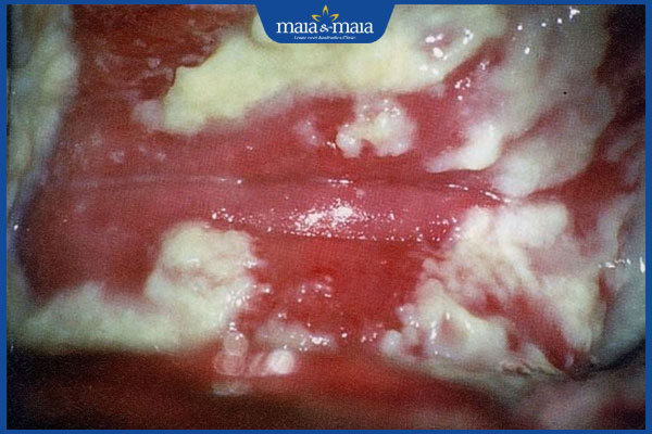 niêm mạc viêm nhiễm