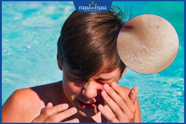 Cách ngăn ngừa tác hại của nước bể bơi với da và tóc 2 nước bể bơi gây khô da