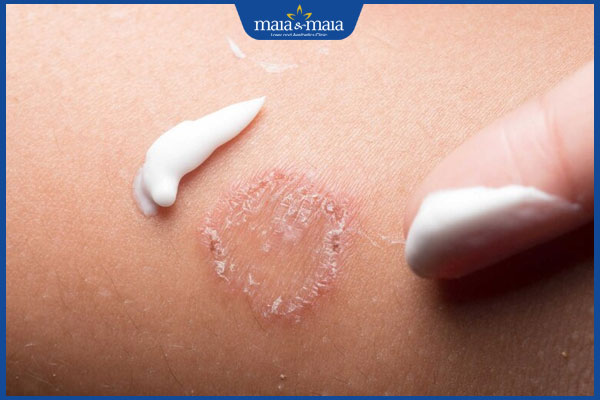 thuốc bôi thoa ngoài da