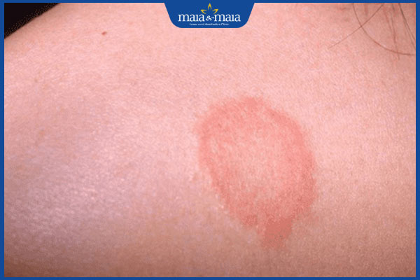 tổn thương hình bầu dục