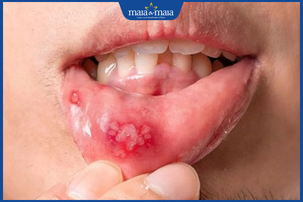 tổn thương viêm loét