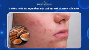 trị mụn bằng bột quế